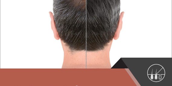Hair Restoration Market – Inkwood Research Hair Restoration Market